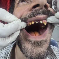 اقساطی کامپوزیت دندان عصبکشی و روکش سرامیکی