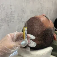 تخفیف ویژه بوتاکس پی ار پی مزوتراپی مزوژل لوکسیوا
