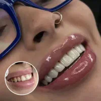 ایمپلنت کره ای آلمانی توسط متخصص فک و صورت