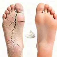 رفع ترک پا کمتر از ۲۰ روز