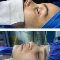 *جراحی عمل بینی