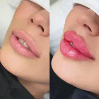 تخفیف ژل بوتاکس صورت و زیربغل مزوتراپی پی ارپی