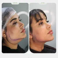 پیکرتراشی و جراحی‌های زیبایی بدن / ساکشن غبغب