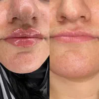 تزریق ژل لب توسط پزشک با تجربه