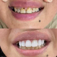 دندانپزشکی ارتودنسی کامپوزیت شرایط ویژه مدت محدود