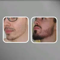 تراکم چند برابری ریش