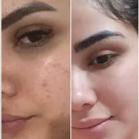 کرم ضد لک گیاهی