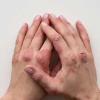 اگزما را قبل از وخیم شدن جدی بگیرید