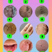 درمان منگوله‌های پوستی زگیل تبخال