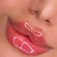 ژل بوتاکس ۳۹۰/ فیلربینی زیرچشم/لیفت صورت شقیقه/نخ