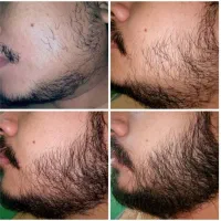 رویش مجدد ریش