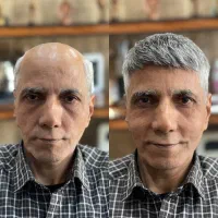 مرکز پروتز مو و کاشت مو