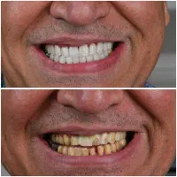 ایمپلنت/ارتودنسی /با شرایط اقساط بدون ضامن