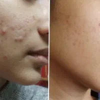 رفع اسکارو فرورفتگی پوست با ضمانت