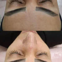 فیشیال و پاکسازی تخصصی پوست (صورت ،کمر و دست)
