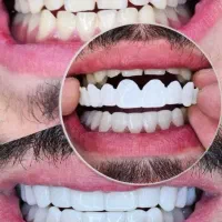 لمینت متحرک دندان(قالبگیری در مطب)