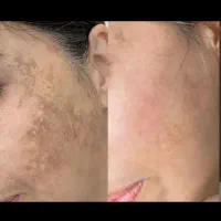 معجزه روشن سازی فوری زیربغل و بیکینی و صورت و لیزر