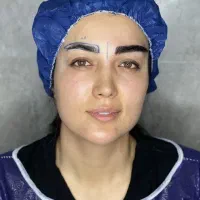 جشنواره تخفیف اقساطی کاشت مو و ابرو