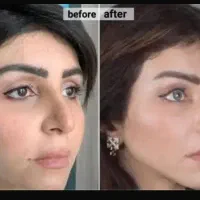 لیپو ابدو برزیلی جراحی بینی لیفت شقیقه پروتز سینه
