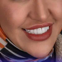 کامپوزیت لب شیشه ای با تکنیک لیرینگ