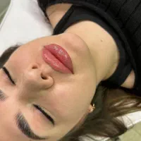 تزریق فیلر (ژل) و بوتاکس در مطب تخصصی