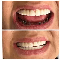 دندان پزشکی ایمپلنت تخصصی اقساطی