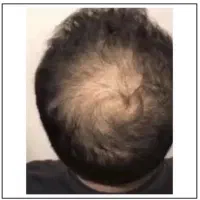 بمب رویش