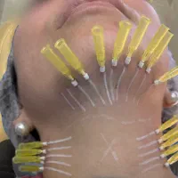 لیفت ابرو و بینی ۲۰ درصد تخفیف (پزشک)