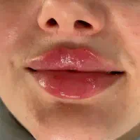 خدمات تزریقات فیلر،ژل،بوتاکس،ژل لب ، گونه فقط ۶۰۰ت