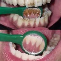 پکیج ویزیت،طرح درمان و جرم‌گیری دوفک باتخفیف ویژه