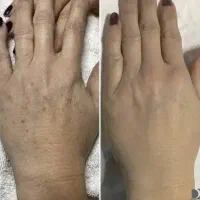 لیزر پلاسما لک و کک مک صورت
