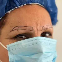 کاشت ابرو و مو تخفیف ۵۰ درصدی