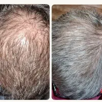 برگشت موهای از بین رفته ات
