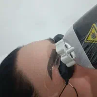 مرکز لیزر زیبا،لیزرموی مشکی سفیدخالبرداری،حذف تتو