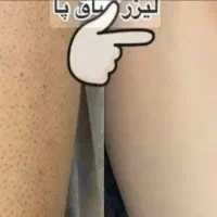 لیزر مو بانوان شاتی کندلا و لیزر پسوریازیس ستارخان