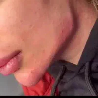 جشنواره تخفیف فیلر وبوتاکس،انواع مزوها،آموزش هنرجو