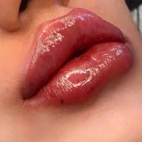 تزریق ژل بوتاکس +لیفت بینی با مواد تضمینی