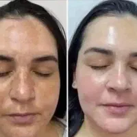 آموزش ژل و بوتاکس و مزو و مزوژل و خدمات