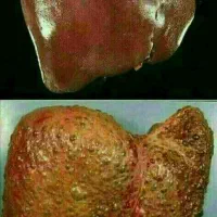کبد چرب بیماری خاموشه اما کشنده