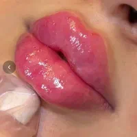 ژل،بوتاکس،فیلربادی باسن بیکینی،پی ارپی زاویه سازی