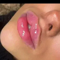 تزریق ژل و بوتاکس پی ار پی جشنواره در مطب