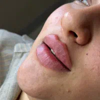 انجام تزریق ژل بوتاکس مزو ها و پیرسینگ