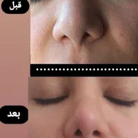 فشیال و پاکسازی تخصصی پوست