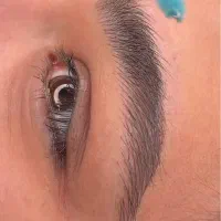 میکروبلیدینگ ،شیدینگ لب ، ریموو