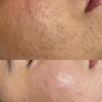 فیشیال تخصصی اراف مزو تکنیک پوست شیشه ایی ۵۰٪اف