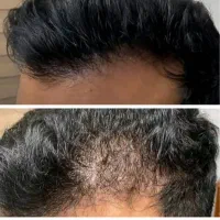 رویش مجدد موهاتو تجربه کن