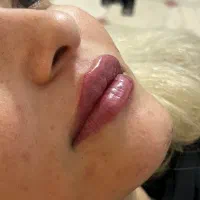 فیلر و‌بوتاکس
