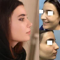 جراحی بینی ،تخفیف 50درصد در تهران