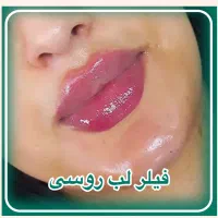 تزریق تخصصی ژل لب روسی و نچرال|خدمات آرایشگری و زیبایی|ارومیه, |دیوار