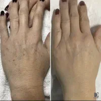 لیزر پلاسما کک‌ومک و لک صورت